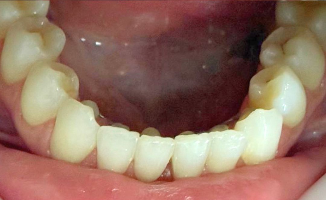 Depois do tratamento Invisalign