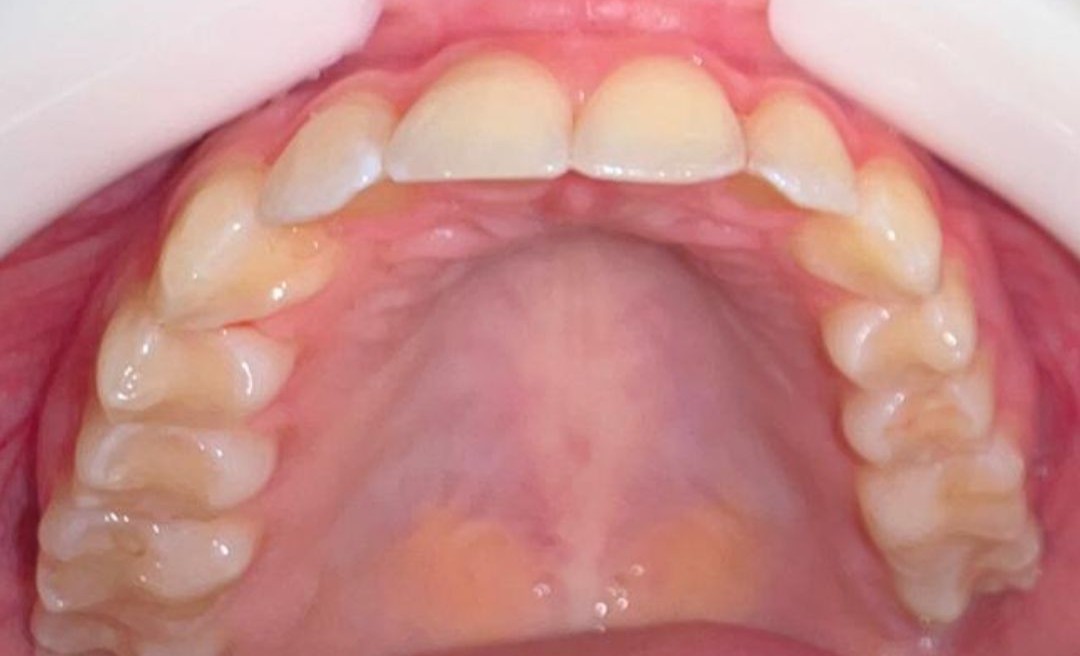 Depois do tratamento Invisalign 2
